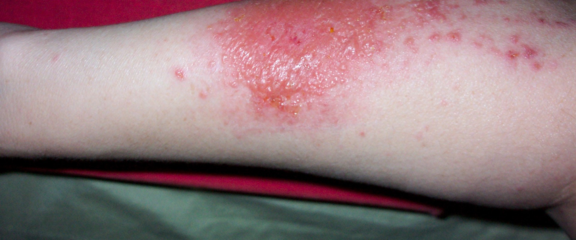 What's poison ivy rash look like?