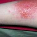 Are poison ivy blisters contagious?