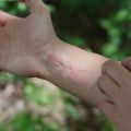How do you get rid of poison ivy overnight?