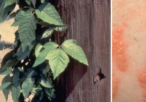 What can be mistaken for poison ivy rash?