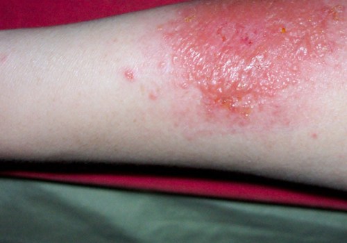 What's poison ivy rash look like?